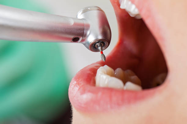 Best Emergency Tooth Extraction in Fallbrook, CA